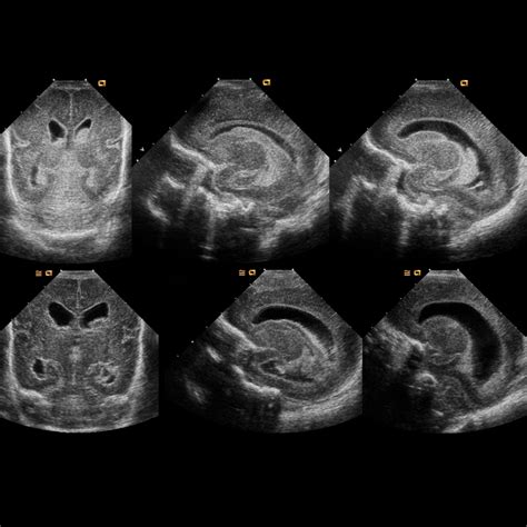 Premature Newborn Baseline Screening Head Ultrasound Exam On Day Of