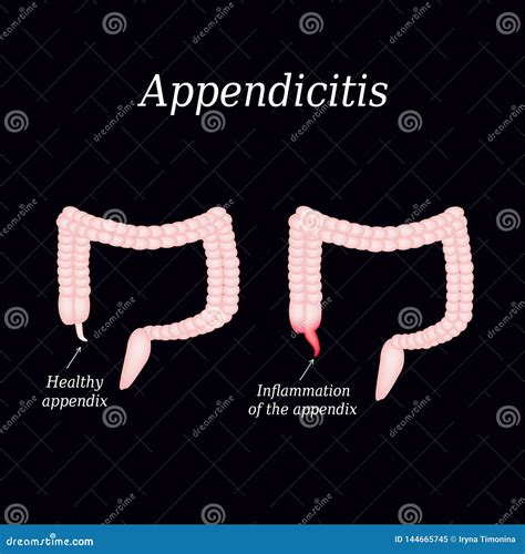 Appendicitis Inflammation Of The Appendix Colon The Illustration On A Gray Background Cartoon