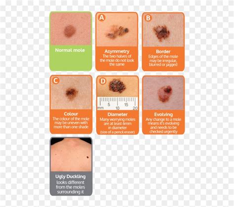 Non Melanoma Skin Cancer Skin Cancer Symptoms Hd Png Download 500x678 5221808 Pngfind