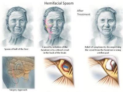 Hemifacial Spasm Effective Treatment Seattleneurosciences