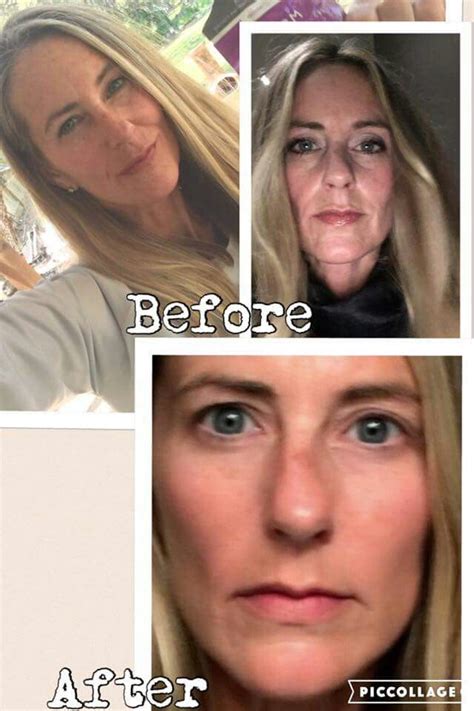 Before And After Photos Of A Womans Face