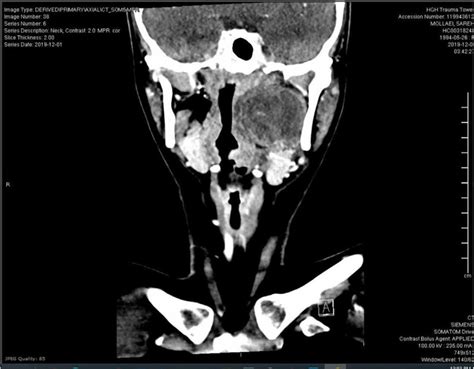 Coronal Cut Of Neck Ct With Contrast Download Scientific Diagram