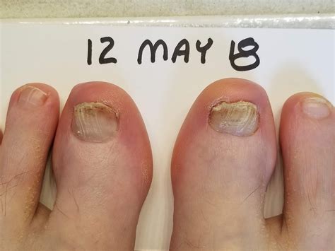 Run With Perseverance A Tale Of Two Toenails How To Fix Runners Toenails