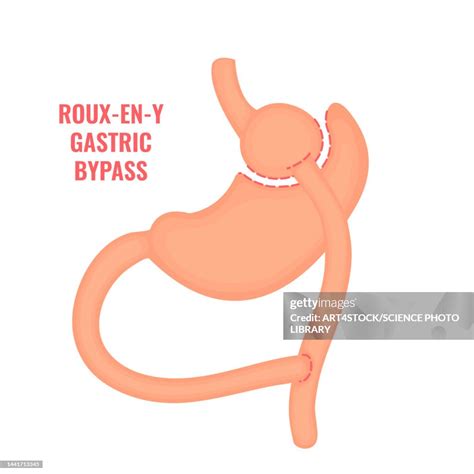 Rouxeny Gastric Bypass Bariatric Surgery Illustration High Res Vector