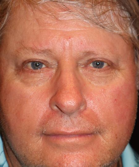 Before And After Gallery Laser Assisted Oculofacial Surgery