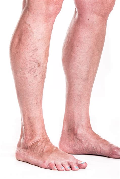 You can also call your. Ultrasound Guided Foam Sclerotherapy- Efficacy & Uses