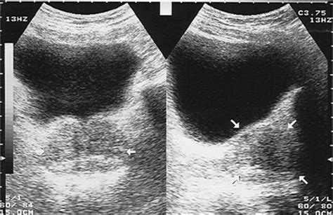 Transrectal Ultrasonographic Measurement Of Prostate Dimensions By