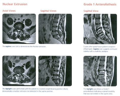 Back Pain All In The Mind Upright Mri Vs Supine Mri Insights