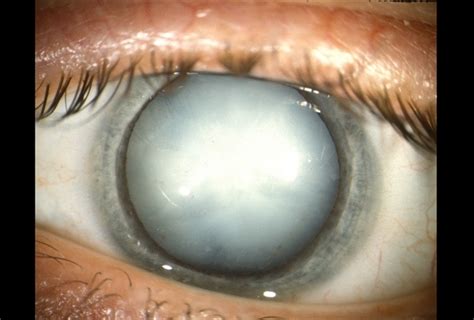 Hypermature Cataract Retina Image Bank