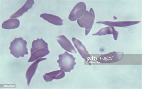 Sickle Cell Micrograph Stockfotos En Beelden Getty Images