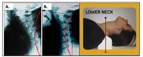 Icd 10 Cm Code For Cervical Lordosis