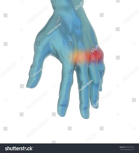 Showing Metacarpal Fractures Hand Bone Pain Stock Illustration 300187949