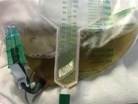 Image Of The Week Green Colored Urine Following A Motor Vehicle