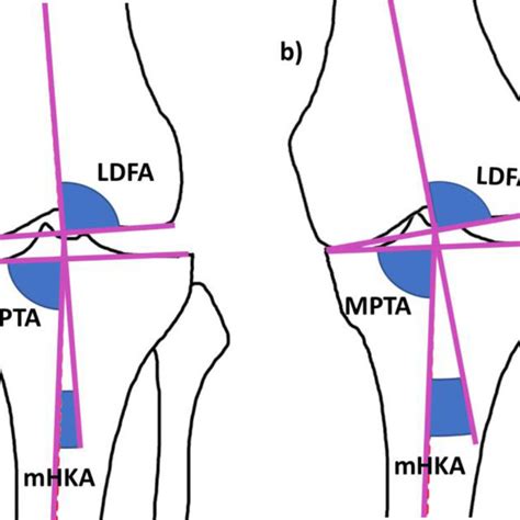 Arithmetic Hip Knee Ankle Angle Ahka And Mechanical Hip Knee Ankle