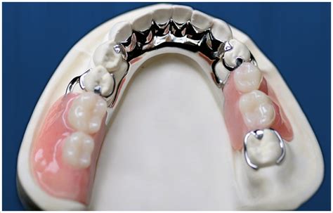 Removable Prosthodontics Partial And Complete Dentures Dental Trends