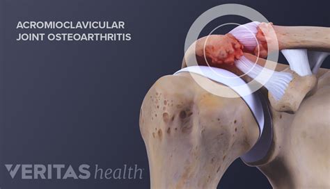 Acromioclavicular Joint Anatomy And Osteoarthritis Arthritis Health