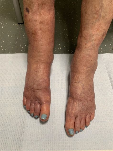 Swollen Purple Feet Causes Diagnosis And Treatment