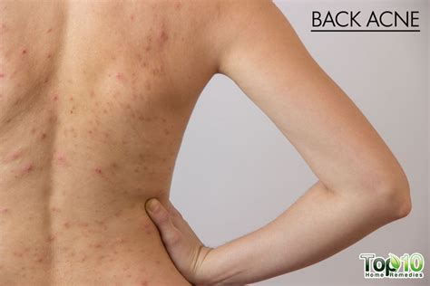 How To Get Rid Of Back Acne Health Beauty Back Acne Treatment