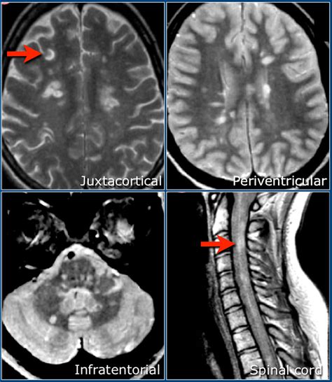 The Radiology Assistant Multiple Sclerosis