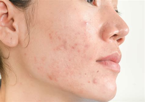 Chin Acne Causes Painful Hormonal Around Under Chin And Treatments