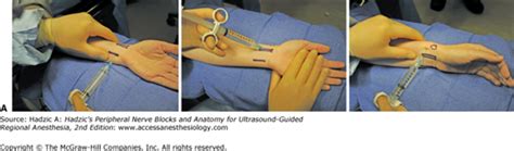 Chapter 16 Wrist Block Hadzics Peripheral Nerve Blocks And Anatomy