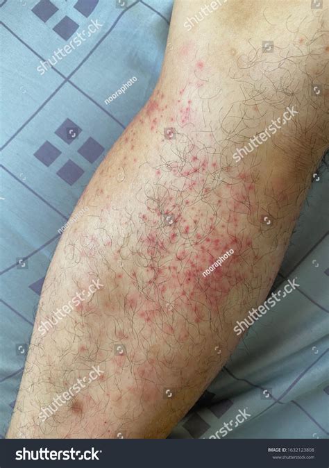 Atopic Dermatitis Rashes On Man Leg ภาพสต็อก แก้ไขตอนนี้ 1632123808