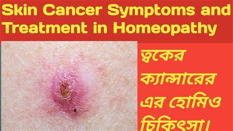 Skin Cancer Symptoms And Treatment In Homeopathy Youtube