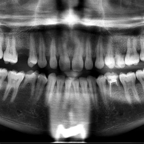 Ntraoral Picture Showing Retained Primary Second Molars In The Maxilla