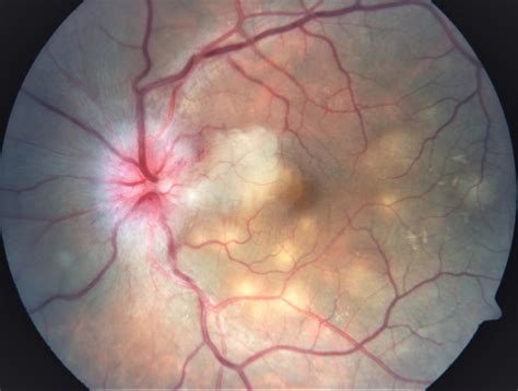 Ocular Tuberculosis Diagnosis And Treatment Approaches