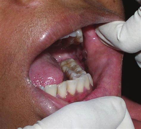 Intra Orally A Swelling Was Noticed In The Left Posterior Buccal