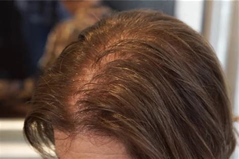 As They Age Women Lose Their Hair Too Which Treatments Really Work