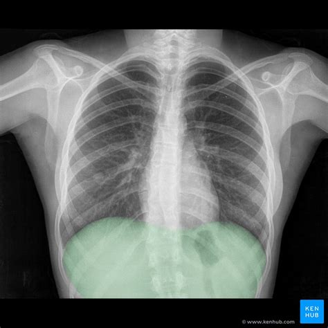 Normal Chest X Ray Anatomy Tutorial Kenhub