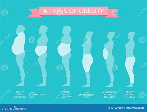 Obesity Types And Causes Cartoon Vector 89382983