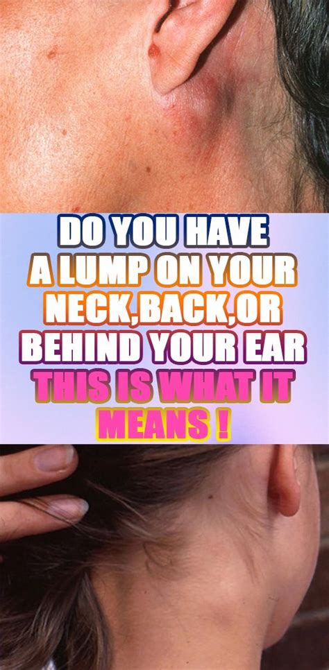 Do You Might Have A Lump On Your Neck Back Or Behind Your Ear This