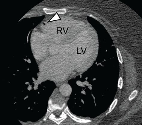 Air Embolism After Peripheral Iv Contrast Injection Cleveland Clinic