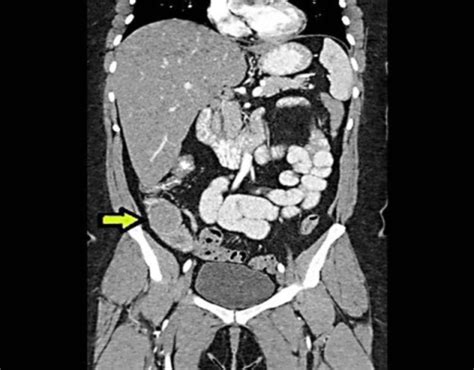 Abdominal Ct Scan Showing Ileoileal Intussusception Wit Open I