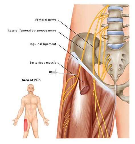 Lateral Femoral Cutaneous Nerve Dermatome