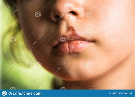 The rest of the herpes appears on the lips with surprising regularity. Herpes On Upper Lip Of Little Girl. Child With Cold Sores On Her Lips. Stock Image - Image of ...