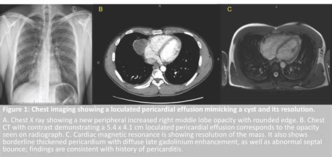 Pericardial Synovial Sarcoma Mimicking Pericarditis In Findings Of My