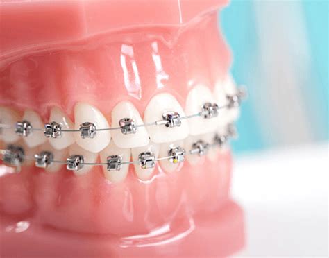 How Do Teeth Move During Orthodontic Braces Feb 16 Skygate Dental