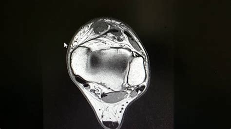 Anterior Tibial Tendon Mri