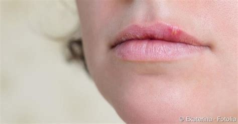 Lippenherpes Verlauf Und Symptome Netdoktorde