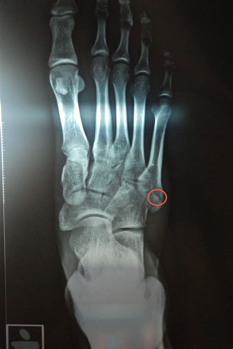 5th Metatarsal Fracture Fracture Treatment