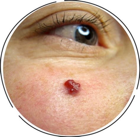 Cherry Angioma Red Dots On Skin Skin We Are In Blog
