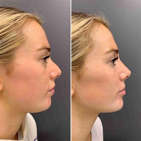 Chin Filler Example 4 Dr Aaron Stanes Anti Ageing And Cosmetic