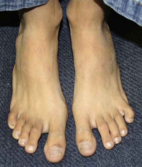 Long Digits On Feet Dolichostenodactyly Photo Also Illustrates