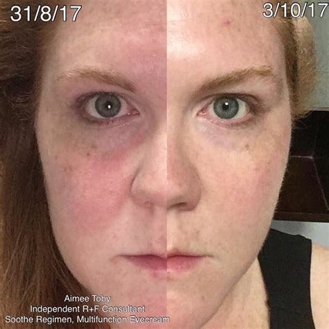 Pin By Emma On R And F Soothe Rodan And Fields Soothe Rodan And