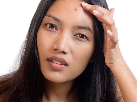Pimples On Forehead Causes Home Remedies And Medical Treatments