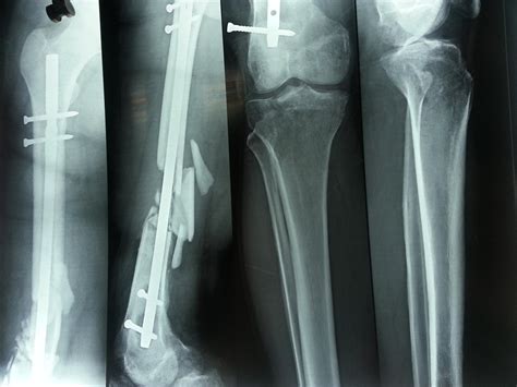 Femoral Shaft Fractures Trauma