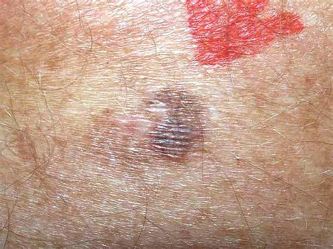 Skin Cancer Spots On Arm Vrogue Co